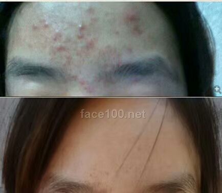 專業祛痘OEM工廠